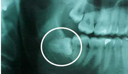 Chirurgia stomatologiczna